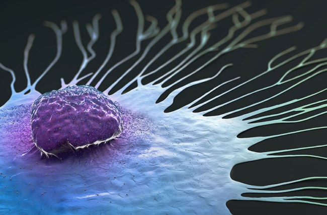 Cáncer de mama metástasis