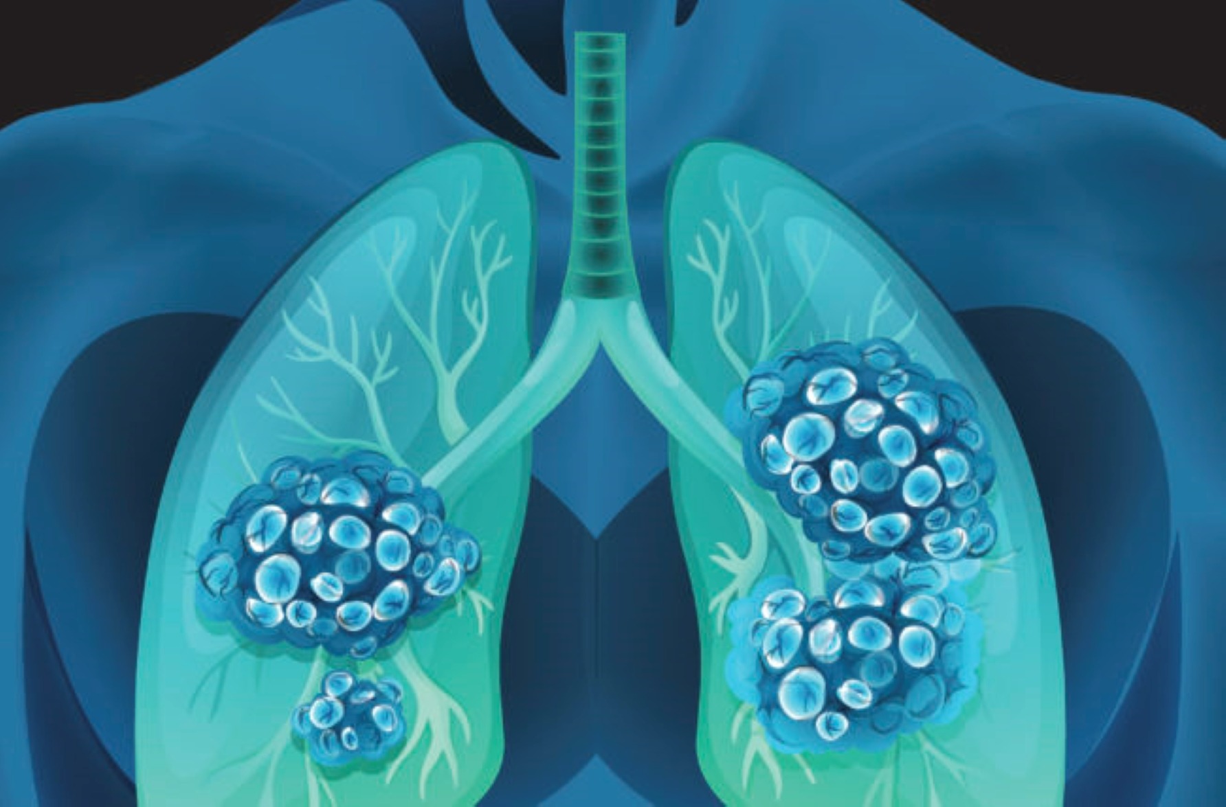 La broncoscopia, el aliado causa de cáncer de pulmón en Guatemala
