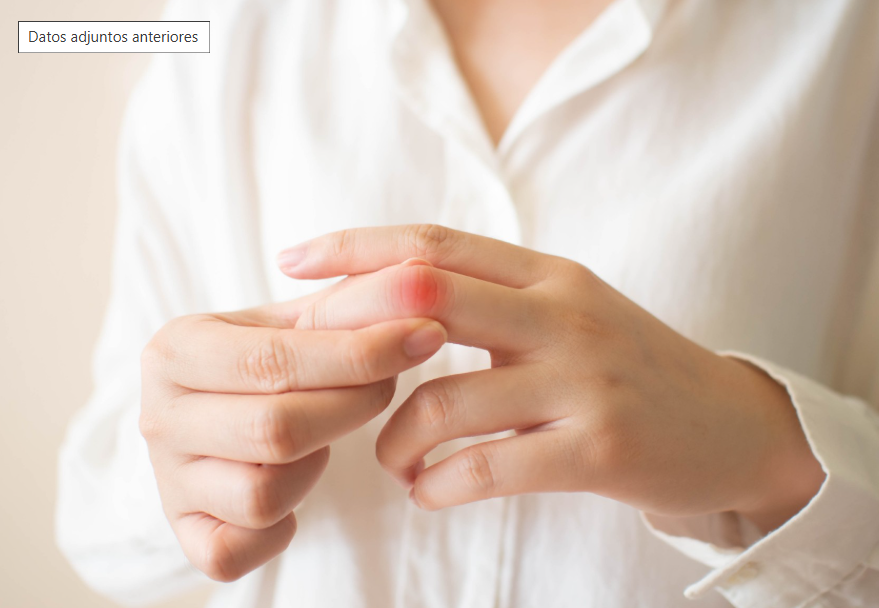 Lupus Eritematoso Sistémico: urge de un diagnóstico temprano