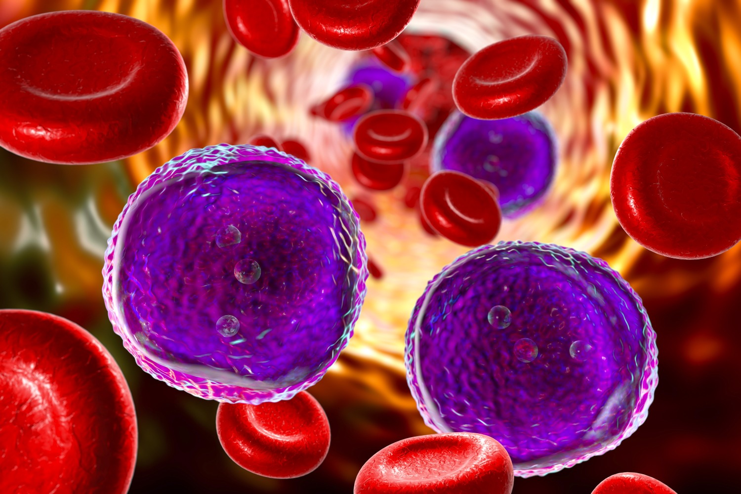 LEUCEMIA LINFOCÍTICA CRÓNICA (LLC)